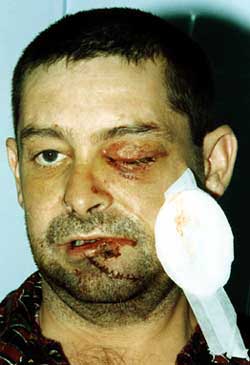 Victim Paul Denvir lost an eye and suffered serious head injuries