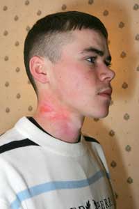 Owen Fitzpatrick said he was held by two PSNI members as another one sprayed him on the face and neck